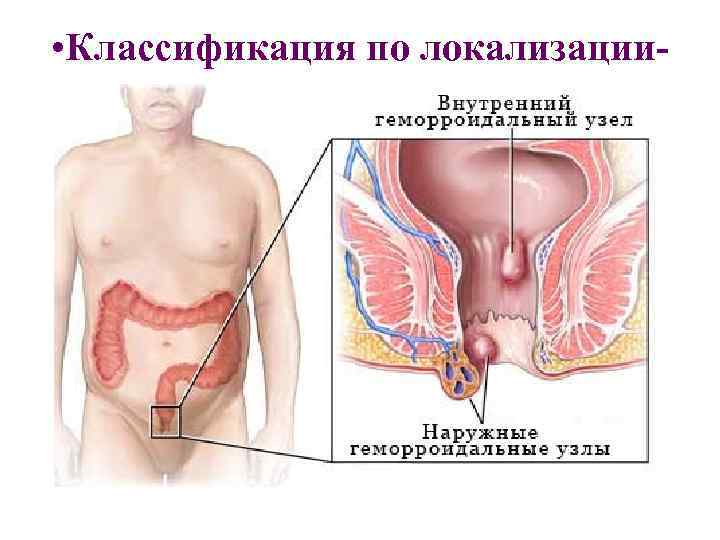  • Классификация по локализации- 
