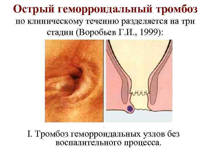 Острый геморроидальный тромбоз по клиническому течению разделяется на три стадии (Воробьев Г. И. ,