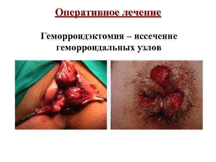 Оперативное лечение Геморроидэктомия – иссечение геморроидальных узлов 