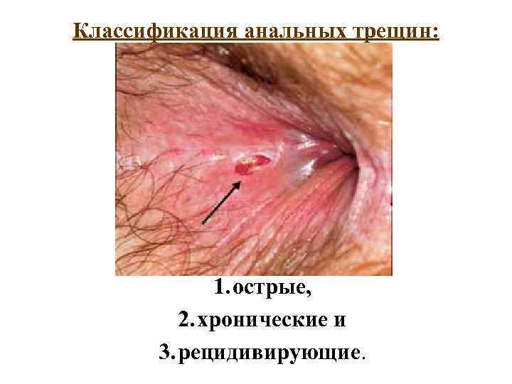 Классификация анальных трещин: 1. острые, 2. хронические и 3. рецидивирующие. 