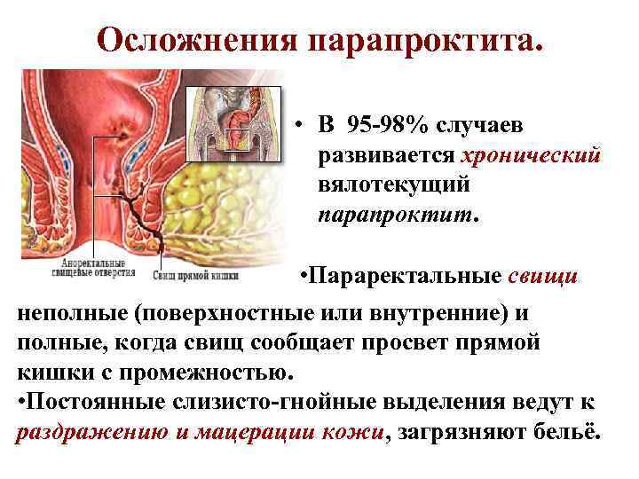 Осложнения парапроктита. • В 95 -98% случаев развивается хронический вялотекущий парапроктит. • Параректальные свищи