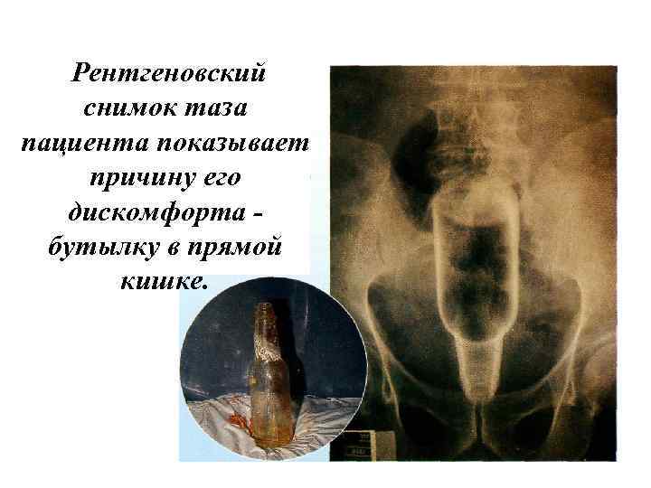 Рентгеновский снимок таза пациента показывает причину его дискомфорта бутылку в прямой кишке. 