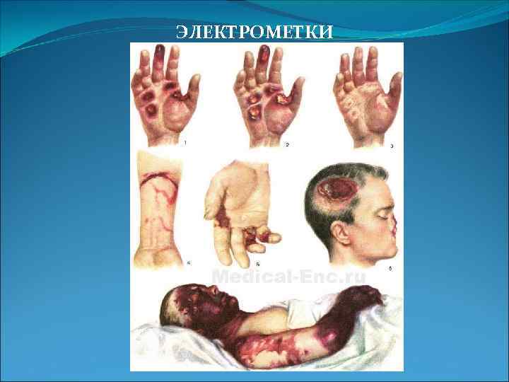 ЭЛЕКТРОМЕТКИ 