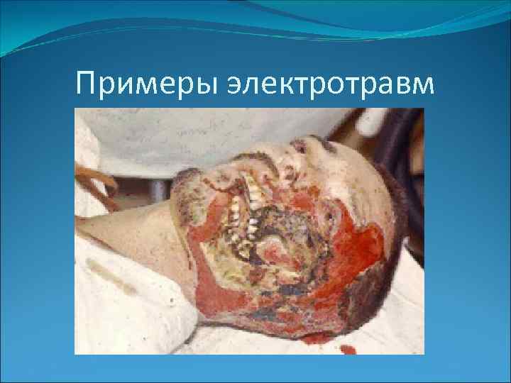 Примеры электротравм 