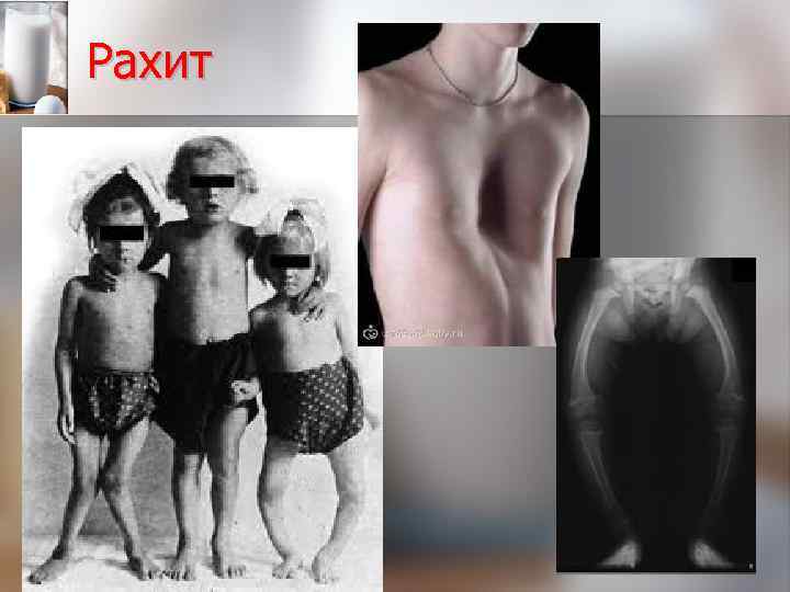 Рахит 
