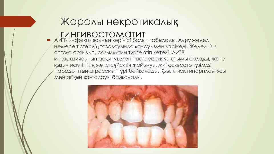 Жаралы некротикалық гингивостоматит табылады. Ауру жедел АИТВ инфекциясының көрінісі болып немесе тістердің тазалауында қанауымен