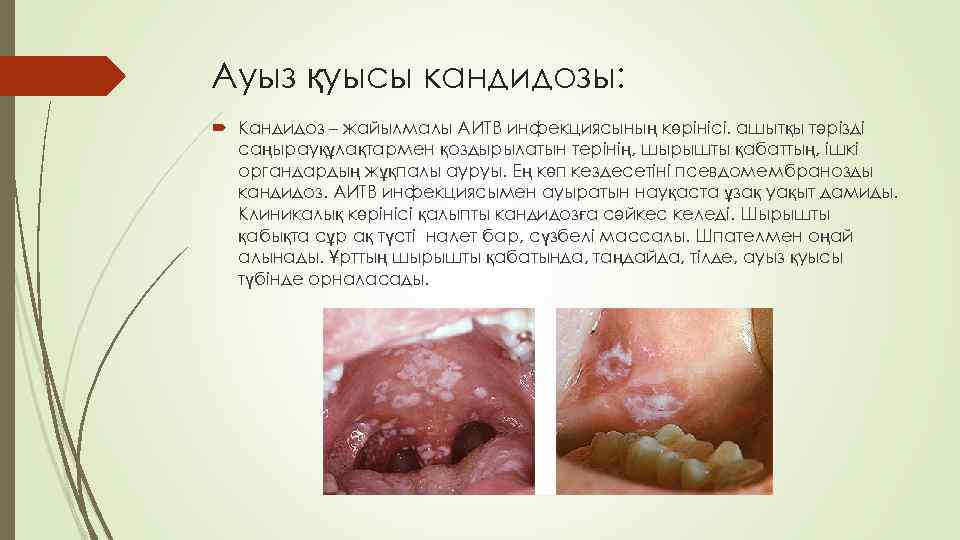 Ауыз қуысы кандидозы: Кандидоз – жайылмалы АИТВ инфекциясының көрінісі. ашытқы тәрізді саңырауқұлақтармен қоздырылатын терінің,