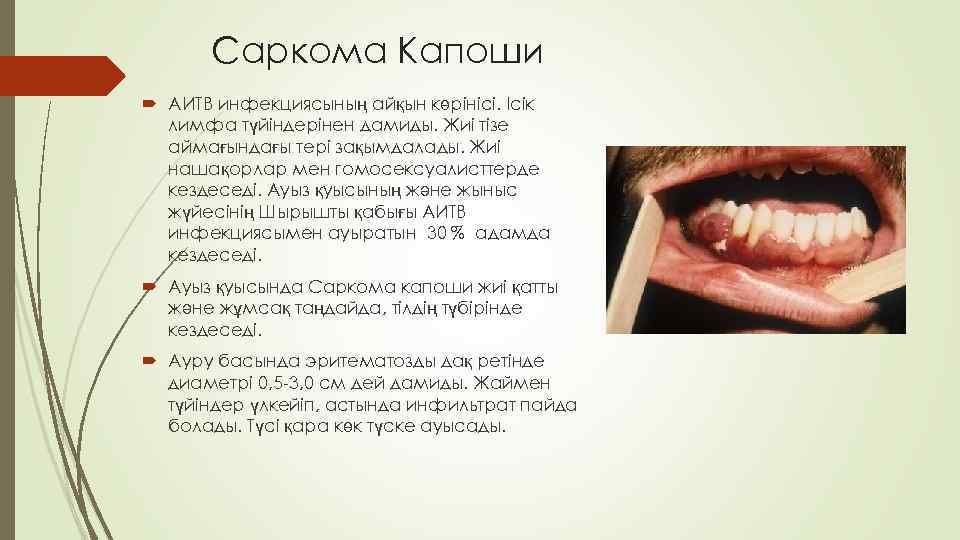 Саркома Капоши АИТВ инфекциясының айқын көрінісі. Ісік лимфа түйіндерінен дамиды. Жиі тізе аймағындағы тері