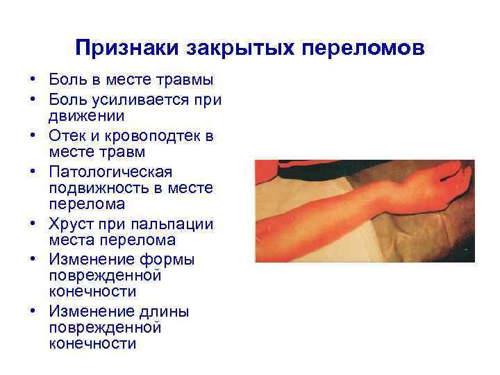 Признаки закрытых переломов • Боль в месте травмы • Боль усиливается при движении •