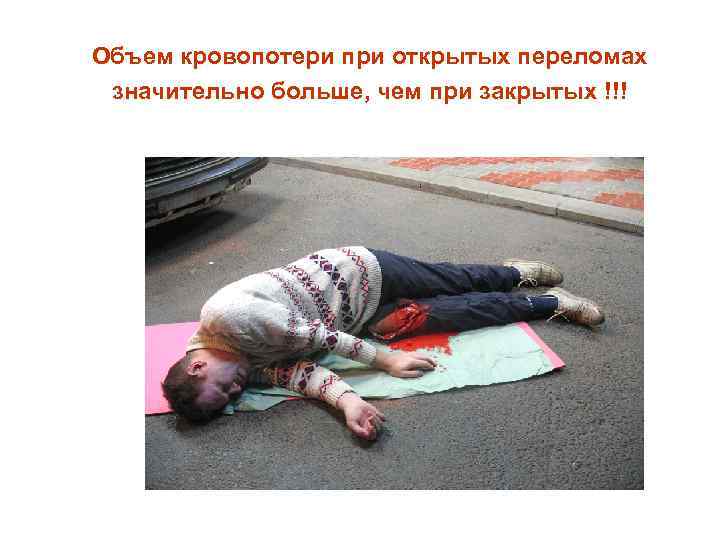Объем кровопотери при открытых переломах значительно больше, чем при закрытых !!! 