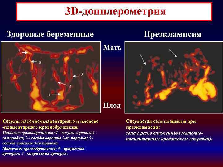  3 D-допплерометрия Здоровые беременные Преэклампсия Мать Плод Сосуды маточно-плацентарного и плодово -плацентарного кровообращения.