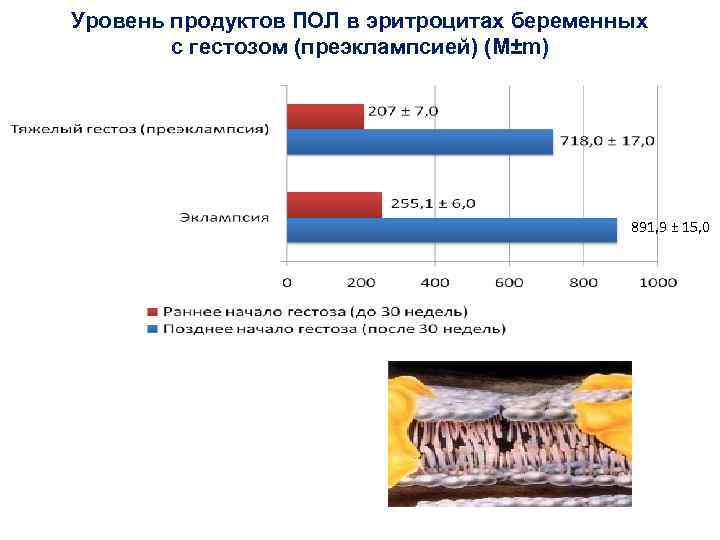 Уровень продуктов ПОЛ в эритроцитах беременных с гестозом (преэклампсией) (М±m) 891, 9 ± 15,