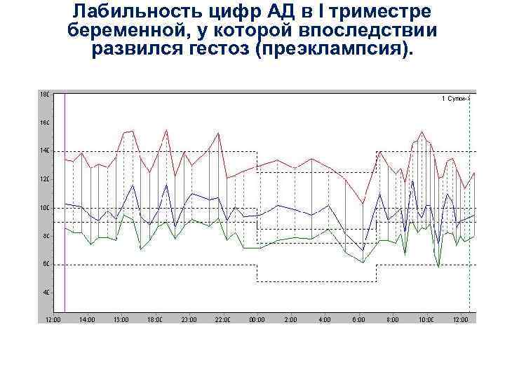 Лабильность цифр АД в I триместре беременной, у которой впоследствии развился гестоз (преэклампсия). 