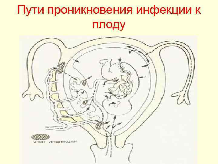 Пути проникновения инфекции к плоду 