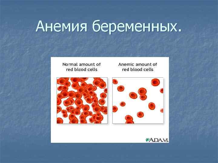 Анемии у беременных презентация