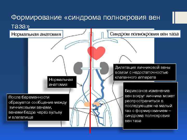 Формирование «синдрома полнокровия вен таза» Нормальная анатомия После беременности образуется сообщение между яичниковыми венами,