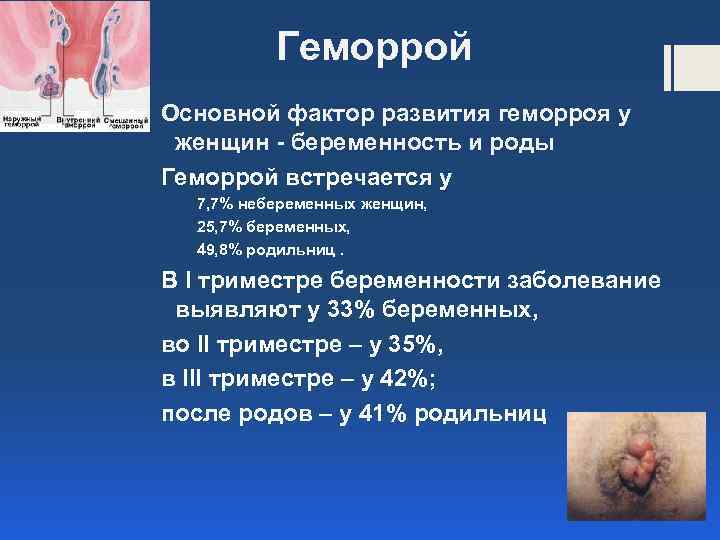 Геморрой Основной фактор развития геморроя у женщин - беременность и роды Геморрой встречается у