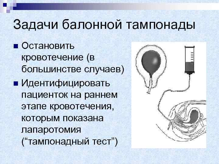 Баллонная тампонада матки презентация