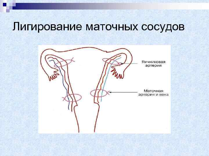 Лигирование маточных сосудов 