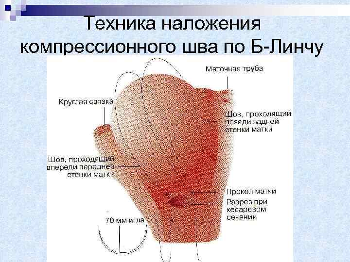 Техника наложения компрессионного шва по Б-Линчу 