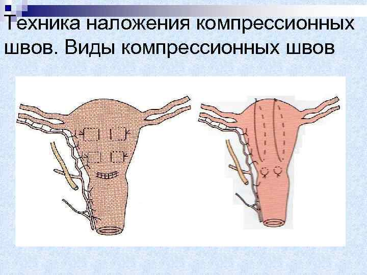 Техника наложения компрессионных швов. Виды компрессионных швов 