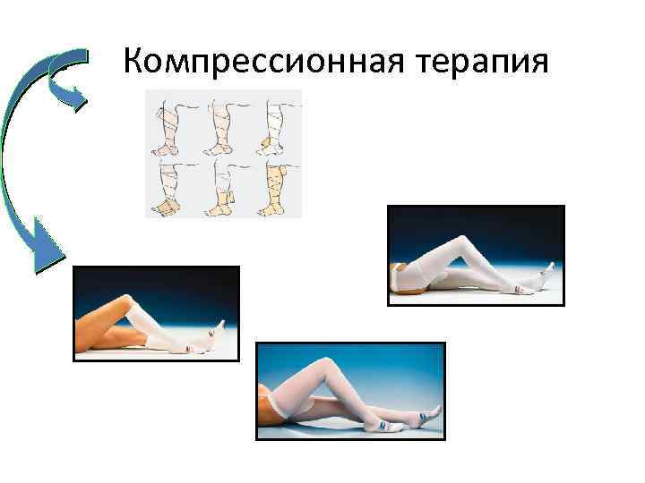  Компрессионная терапия 