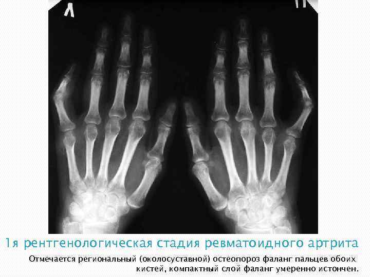 Как выглядит артрит на рентгене фото