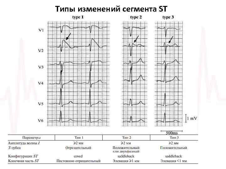 Типы изменений сегмента ST 