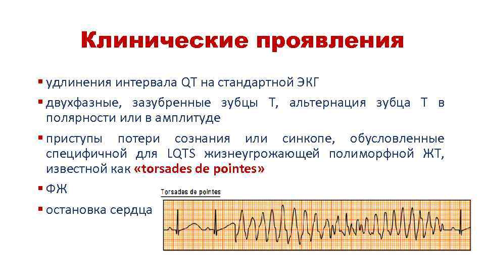 Клинические проявления § удлинения интервала QT на стандартной ЭКГ § двухфазные, зазубренные зубцы Т,