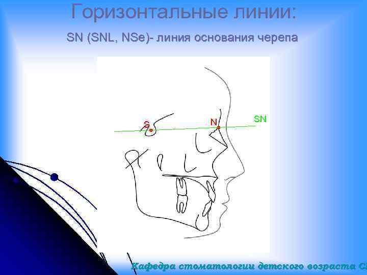 Горизонтальные линии: SN (SNL, NSe)- линия основания черепа S N SN Кафедра стоматологии детского