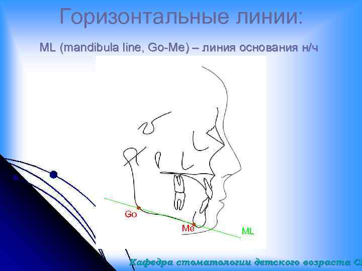 Горизонтальные линии: ML (mandibula line, Go-Me) – линия основания н/ч Go Me ML Кафедра