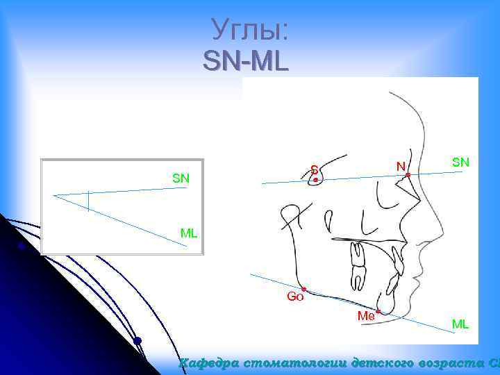 Углы: SN-ML N S SN SN ML Go Me ML Кафедра стоматологии детского возраста