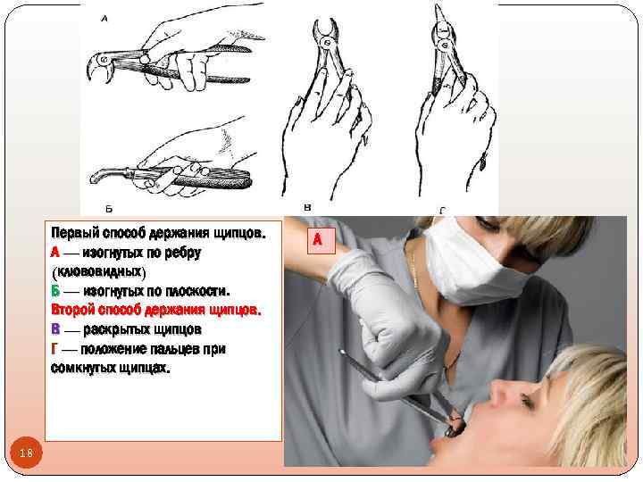 Первый способ. Способы держания щипцов для удаления зубов. Способы держания щипцов в стоматологии. Фиксация щипцов в руке.