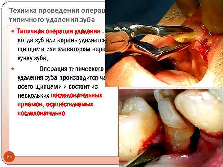 Техника проведения операции типичного удаления зуба Типичная операция удаления - когда зуб или корень