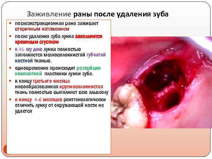 Заживление раны после удаления зуба послеэкстракционная рана заживает 23 вторичным натяжением после удаления зуба