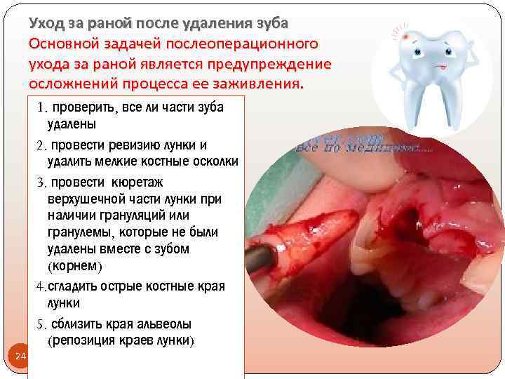Уход за раной после удаления зуба Основной задачей послеоперационного ухода за раной является предупреждение