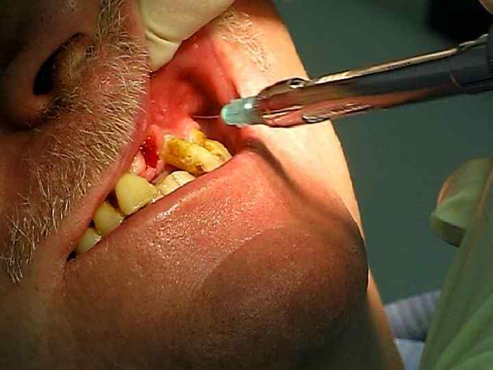 Проводниковая анестезия – это вид МА, при котором м/а вводят в область нерва, проводящего