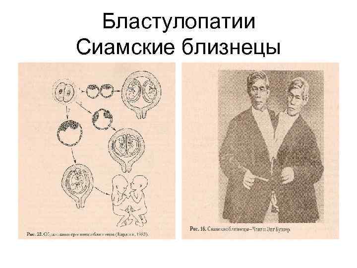 Бластулопатии Сиамские близнецы 