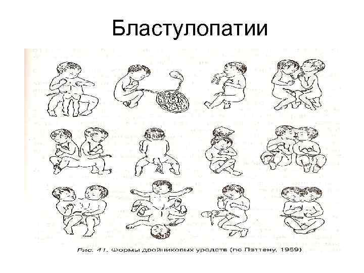 Бластулопатии 