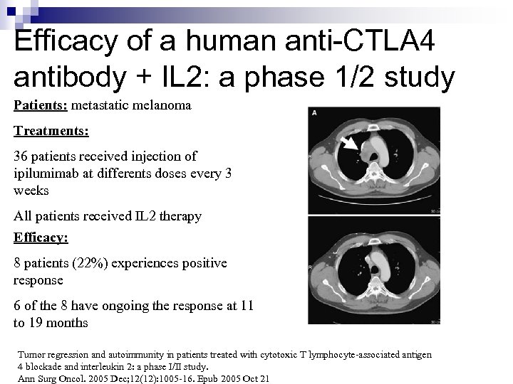 Efficacy of a human anti-CTLA 4 antibody + IL 2: a phase 1/2 study