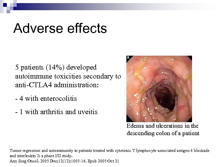 Adverse effects 5 patients (14%) developed autoimmune toxicities secondary to anti-CTLA 4 administration: -