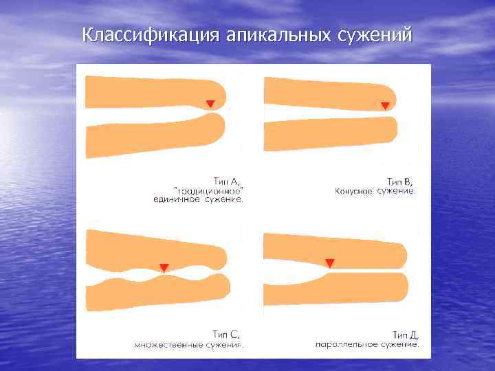 Классификация апикальных сужений 