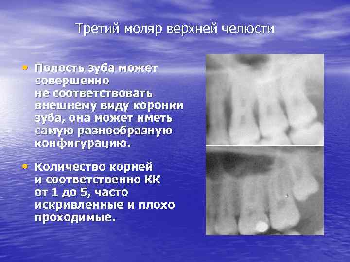 Третий моляр верхней челюсти • Полость зуба может совершенно не соответствовать внешнему виду коронки