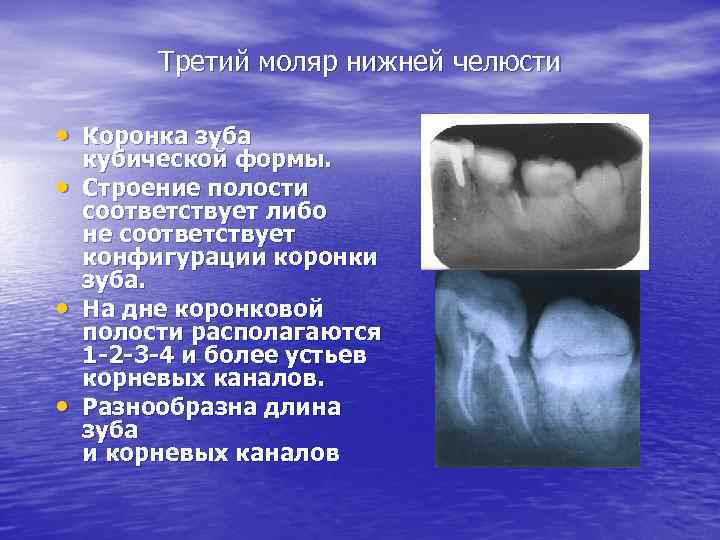 Третий моляр нижней челюсти • Коронка зуба • • • кубической формы. Строение полости