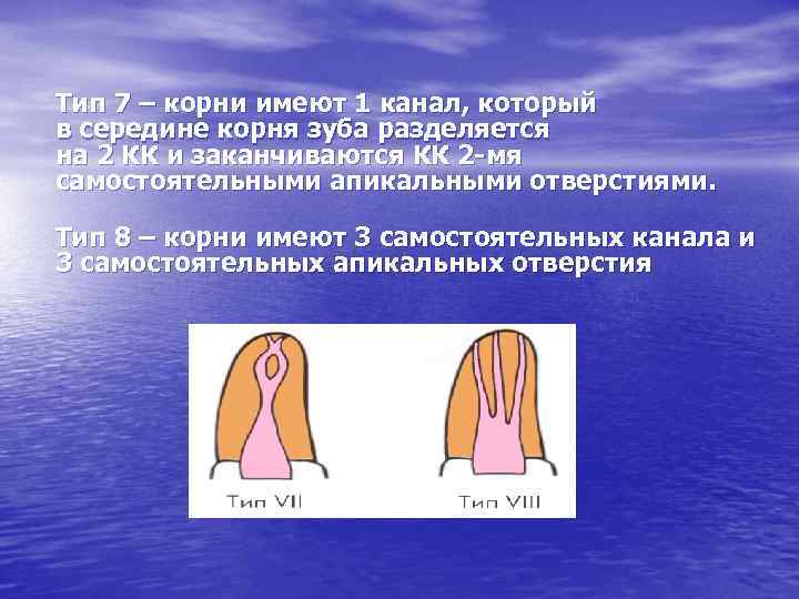 Тип 7 – корни имеют 1 канал, который в середине корня зуба разделяется на