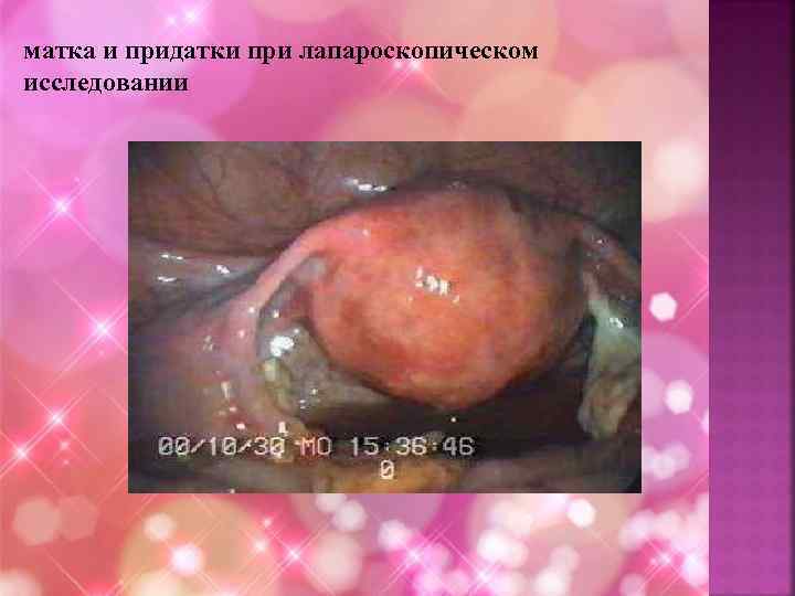 матка и придатки при лапароскопическом исследовании 