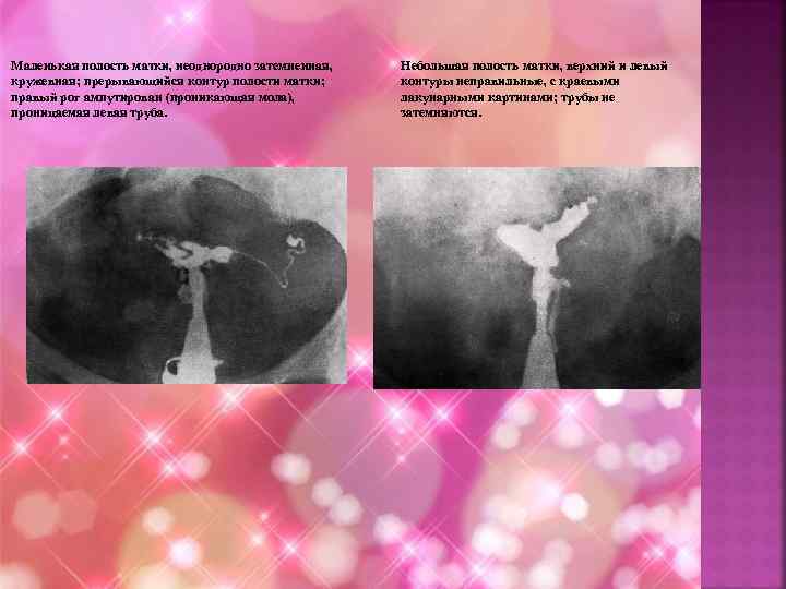 Маленькая полость матки, неоднородно затемненная, кружевная; прерывающийся контур полости матки; правый рог ампутирован (проникающая