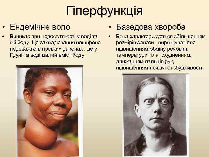 Гіперфункція • Ендемічне воло • Базедова хвороба • • Виникає при недостатності у воді