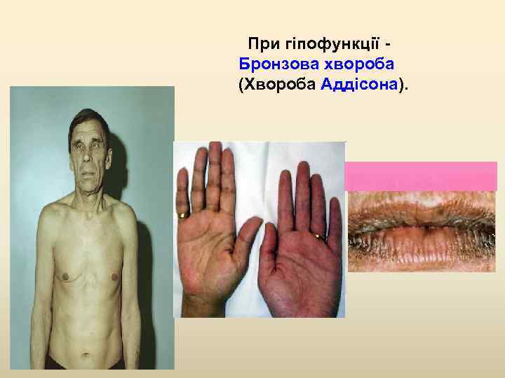  При гіпофункції - Бронзова хвороба (Хвороба Аддісона). 