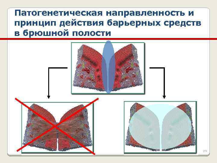 Патогенетическая направленность и принцип действия барьерных средств в брюшной полости 29 